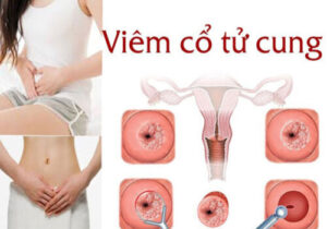 Khám viêm cổ tử cung ở đâu Bách Lạc